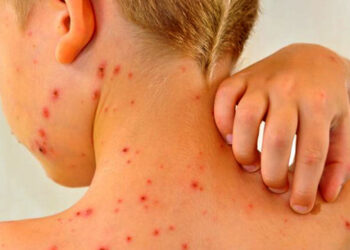 Refuerzan acciones binacionales contra el sarampión en la frontera con Bolivia