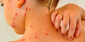 Refuerzan acciones binacionales contra el sarampión en la frontera con Bolivia