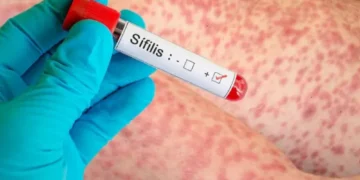 📰 📈 Jóvenes adultos concentran la mayor incidencia de casos de sífilis en Salta