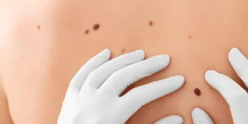 Argentina presenta su primera vacuna contra el cáncer de piel más agresivo